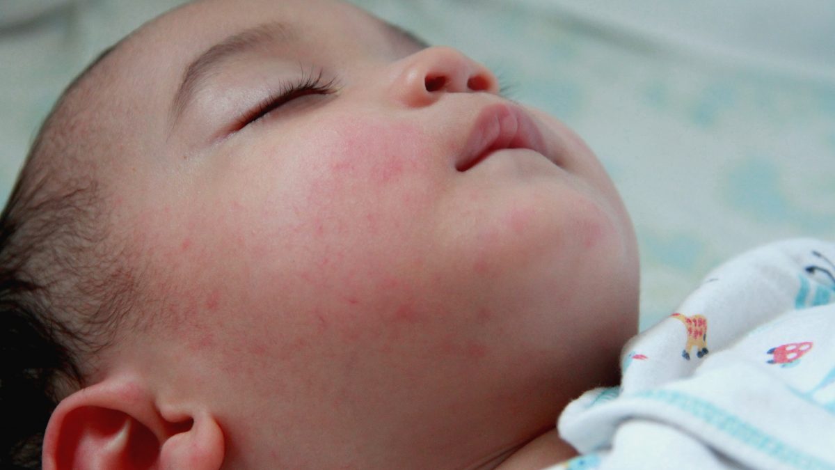 pencegahan rubella
