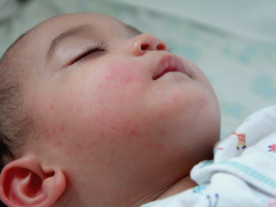 pencegahan rubella