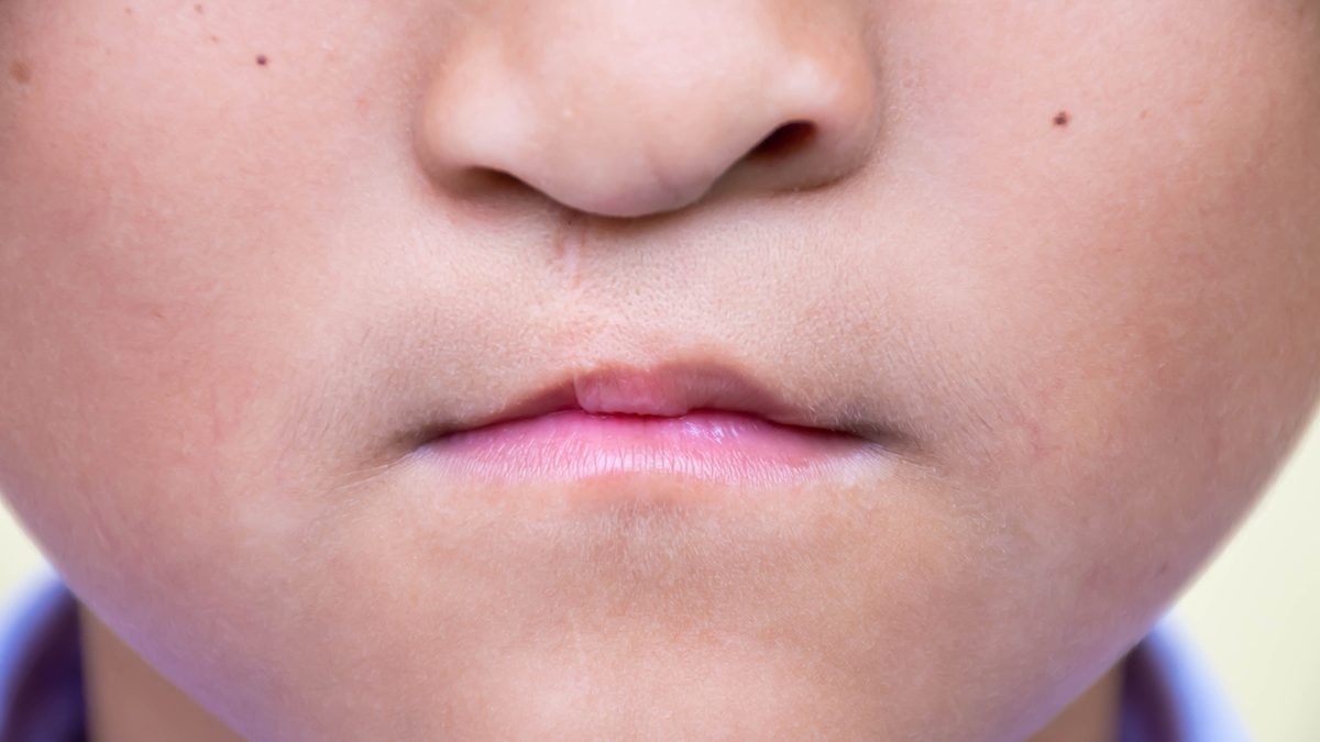 penyebab bibir sumbing