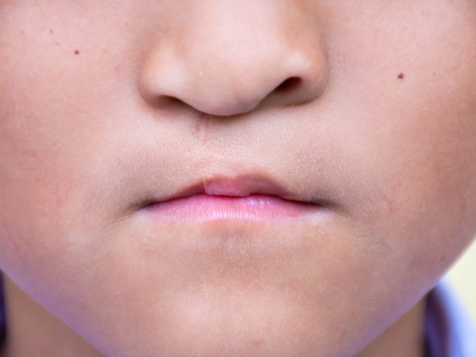 penyebab bibir sumbing