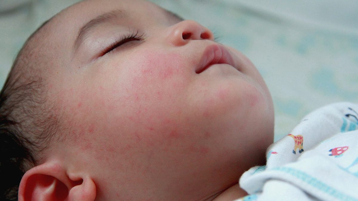 Mangatasi biang keringat pada bayi