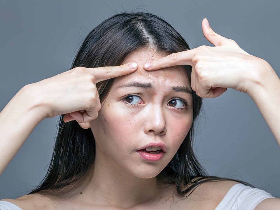 Cara menghilangkan jerawat