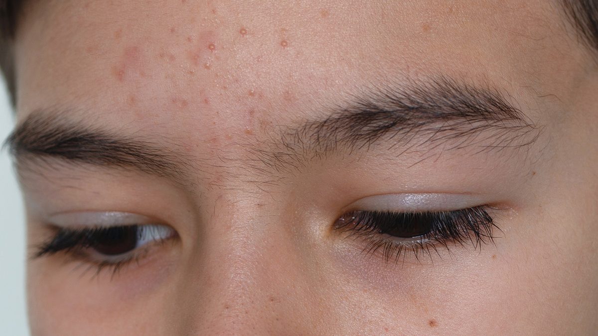 Fungal Acne