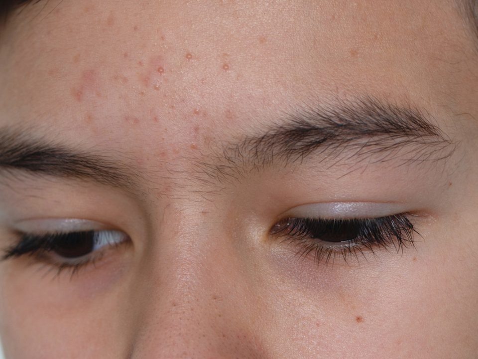 Fungal Acne