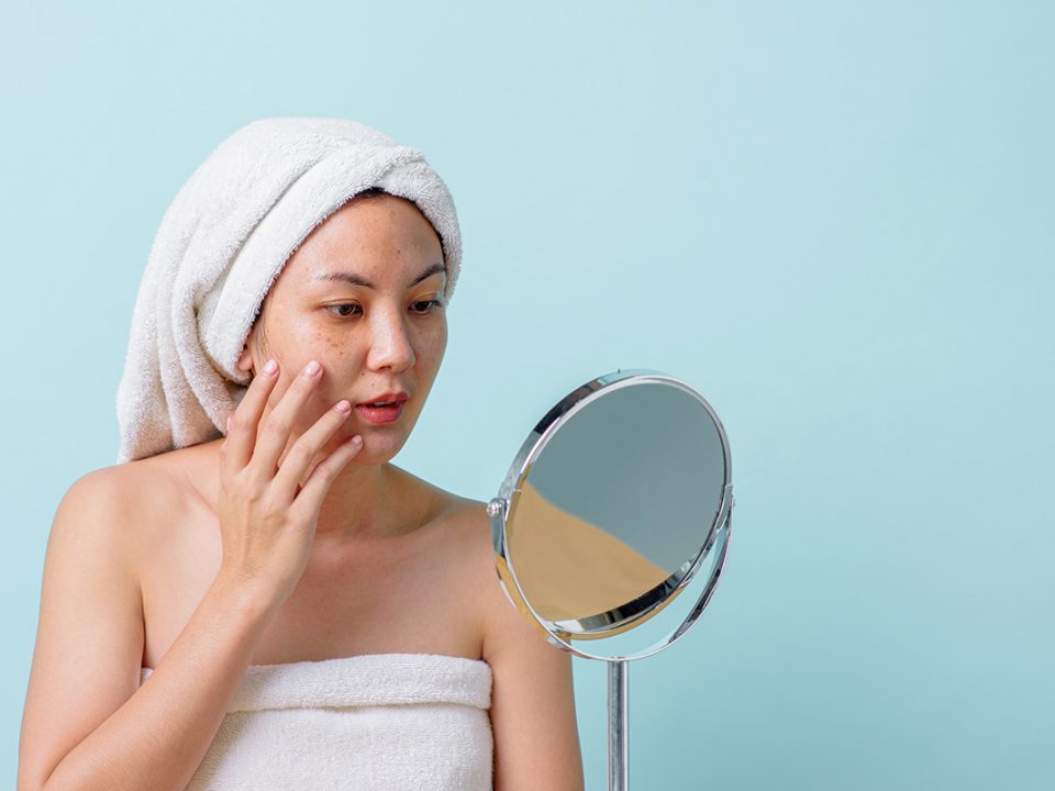 Penyebab Melasma Wajah