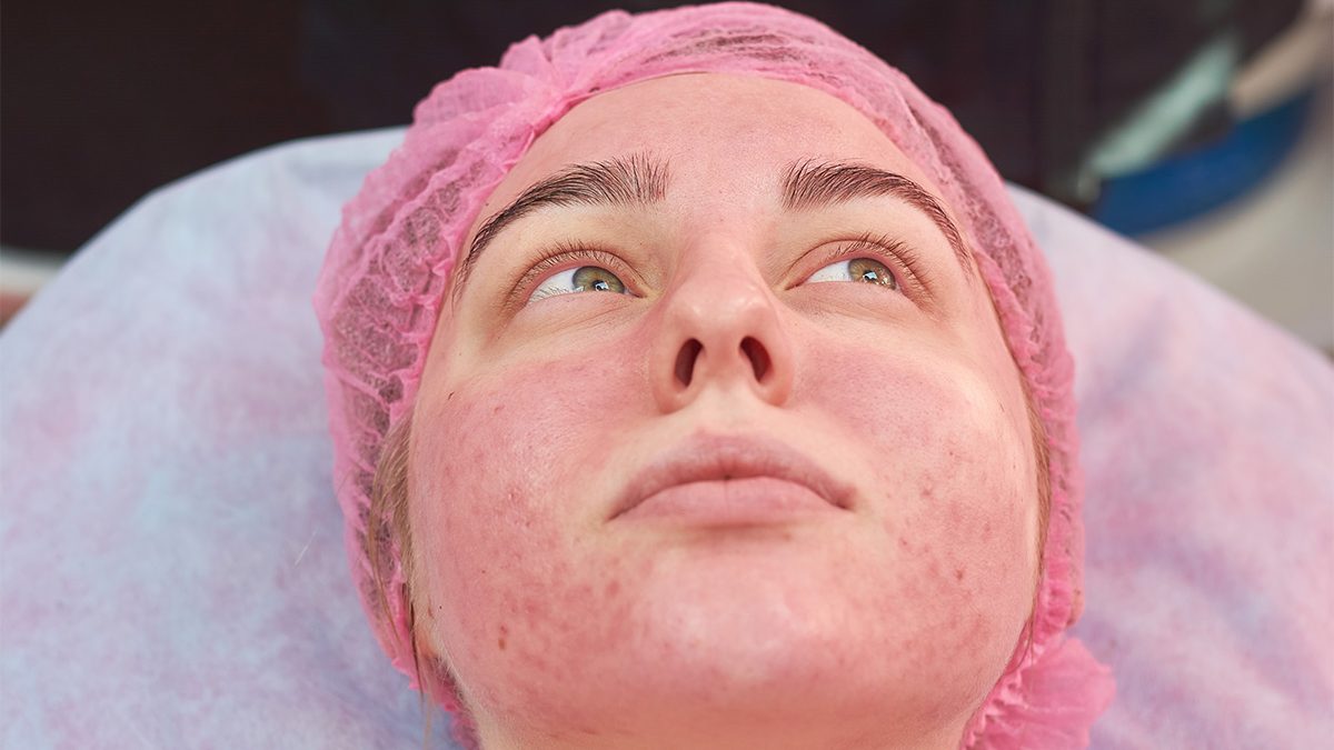 Efek Samping Facial