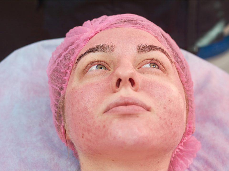 Efek Samping Facial