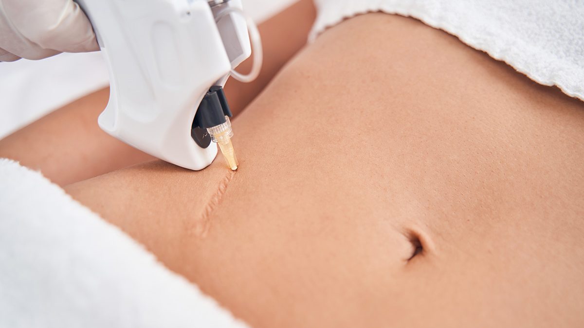 Menghilangkan Keloid