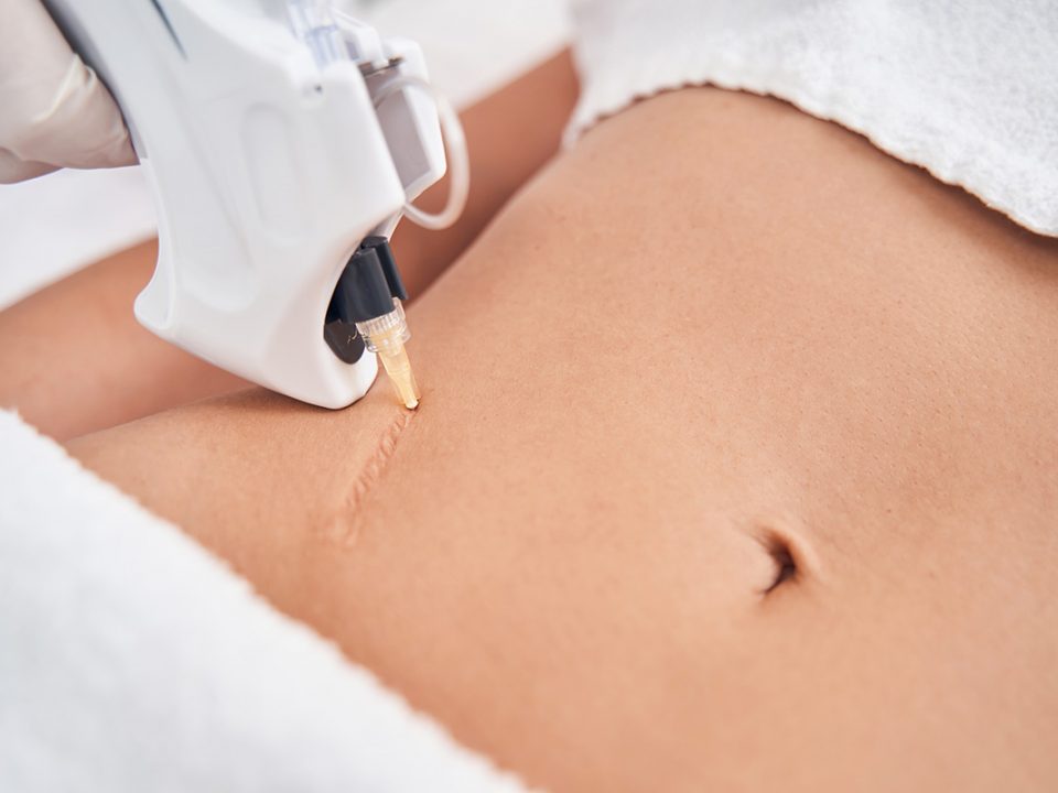 Menghilangkan Keloid