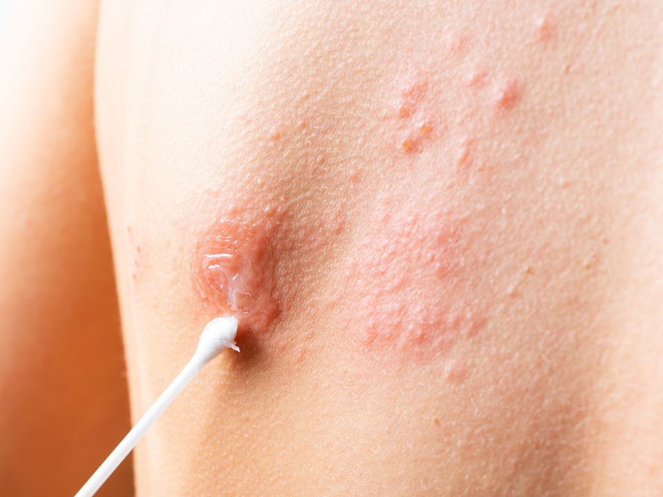 Cara Mengobati Herpes