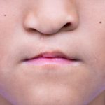 penyebab bibir sumbing