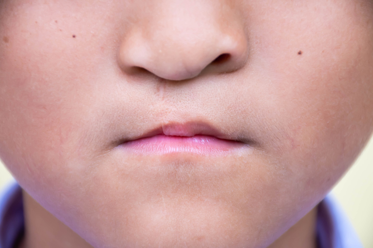 penyebab bibir sumbing