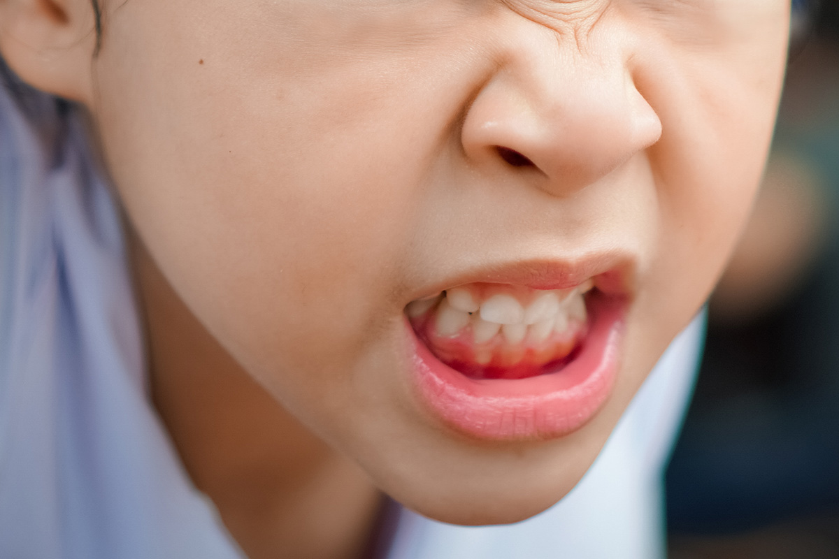 Cara mengatasi anak suka menggigit