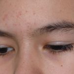 Fungal Acne