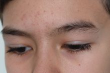 Fungal Acne
